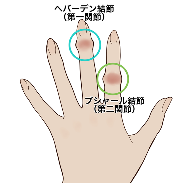 40代以上の女性に多いヘバーデン結節とブシャール結節の違い