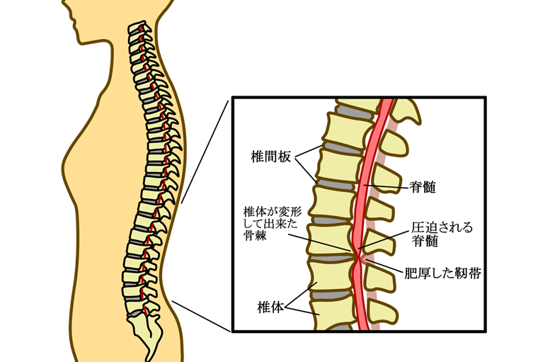 変形性腰椎症とは？