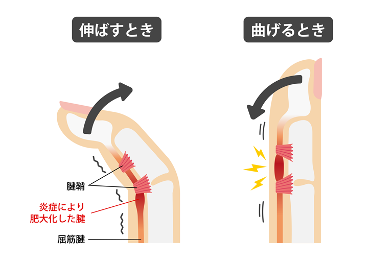 腱鞘炎（ばね指）とは