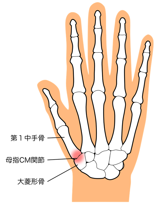 母指CM関節症ってどんな病気？