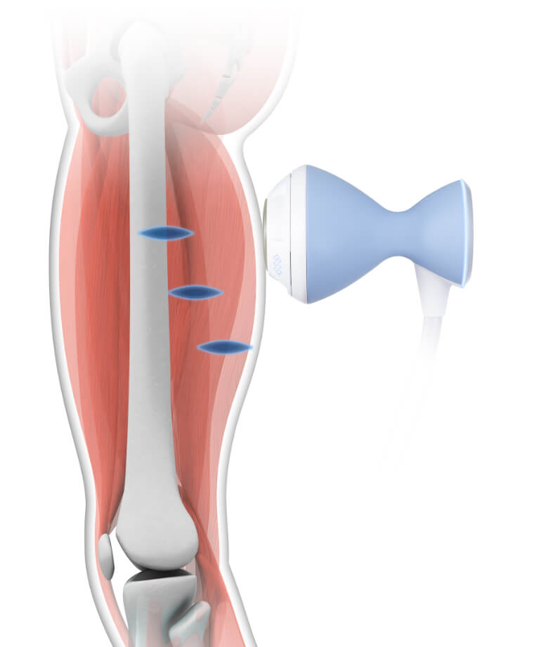 体外衝撃波の効果とメカニズム